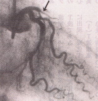 左前下行枝近位部閉塞の冠動脈造影