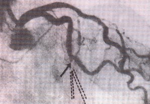 左回旋枝閉塞の冠動脈造影