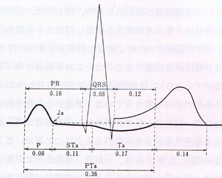 心房性Ｔ波と心室群波形との時間的関係