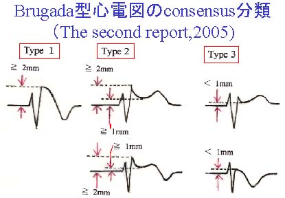 第二次コンセンサス分類によるBrugada型心電図の診断基準（波形）