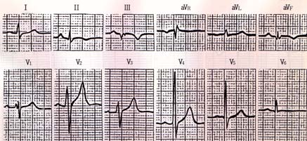 心電図第14例の標準誘導心電図