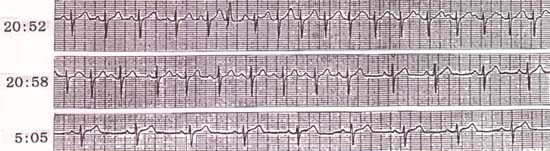 ホルター心電図に記録された頻脈発作