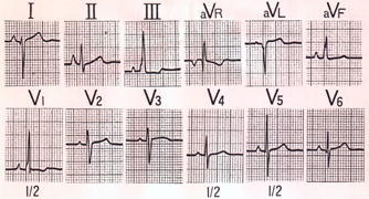 フアロー四徴症の心電図（右室収縮期性負荷）
