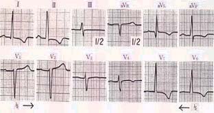 高血圧症例の標準誘導心電図