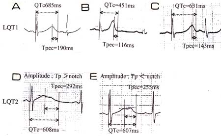 LQT1およびLQT2のV5誘導に見られた典型的心電図波形と再分極指標計測方法