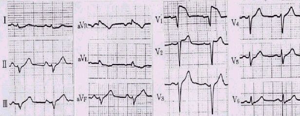 心膜心筋炎で入院当日の心電図