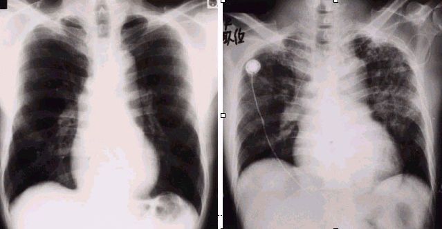 心膜心筋炎発症前後の胸部Ｘ線写真