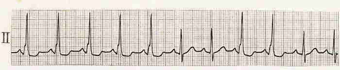 間欠的WPW症候群の心電図